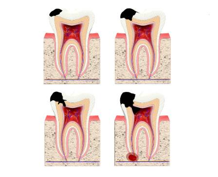 The Stages of Caries Development 3D Model