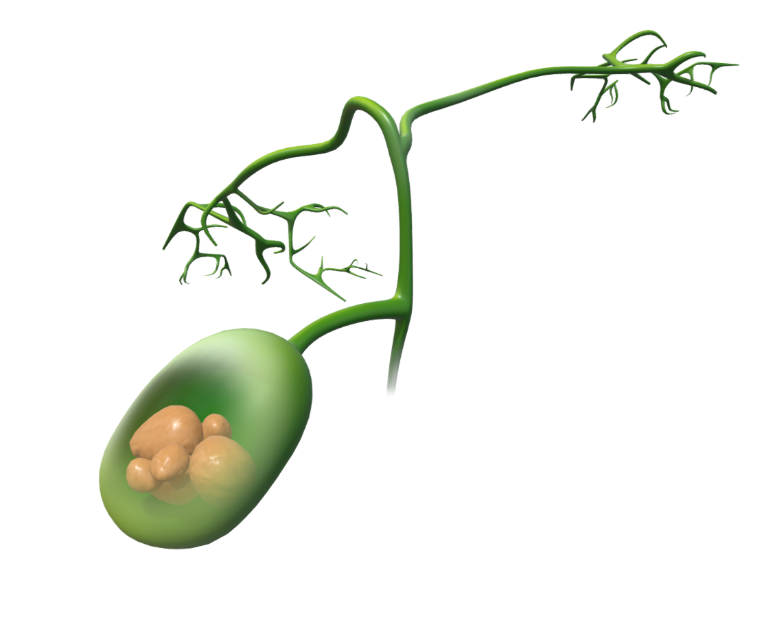 Gallbladder with Gallstones